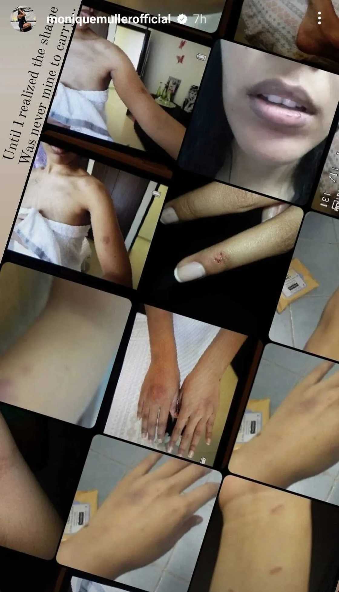 Monique Muller shared pictures of her bruises Monique Muller shared pictures of her bruises
