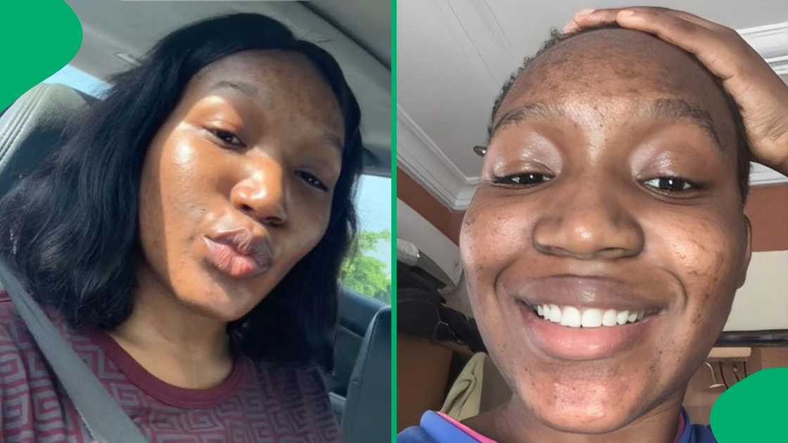 A woman went from having acne to flawless skin.