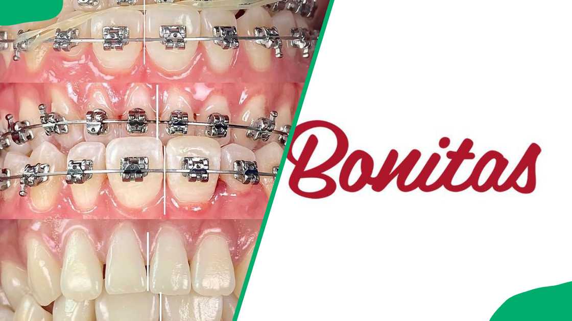 An illustration of braces. Bonitas logo. An illustration of braces. Bonitas logo.
