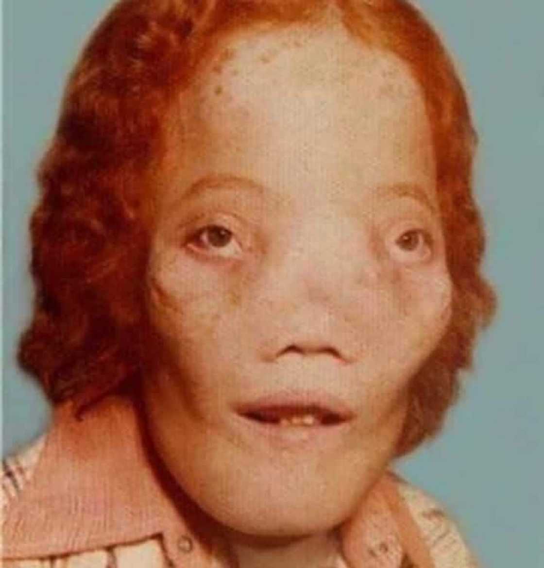 Rocky Dennis Rocky Dennis