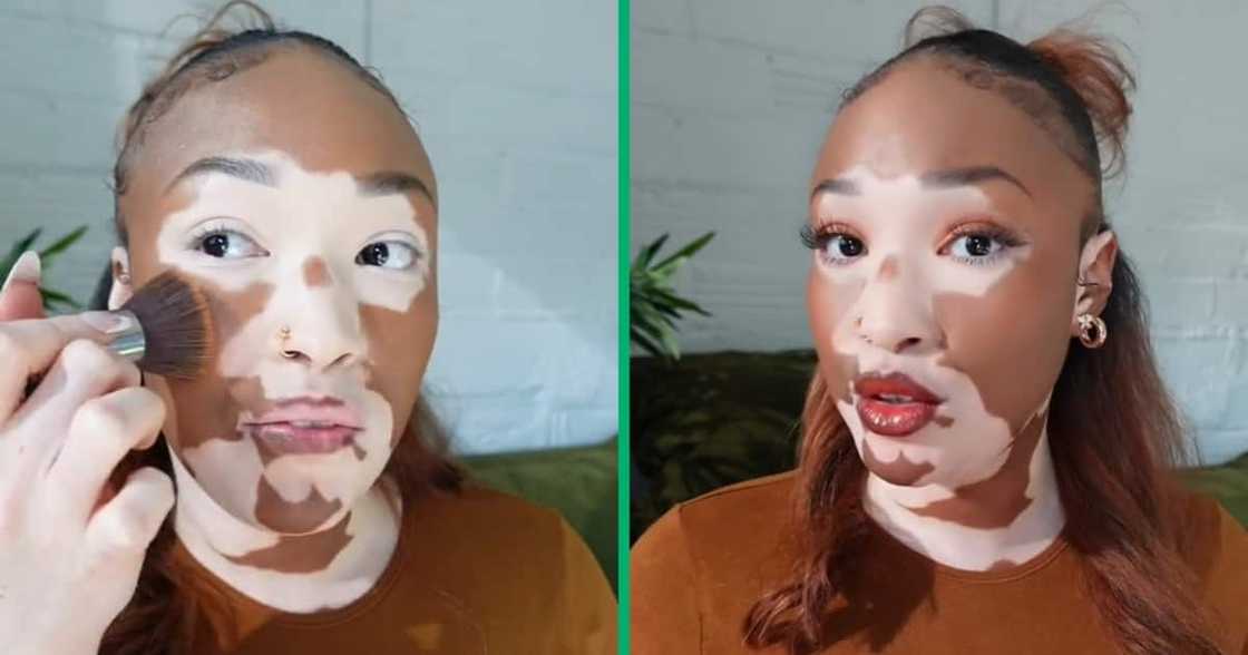 A woman with vitiligo posted a makeup video A woman with vitiligo posted a makeup video