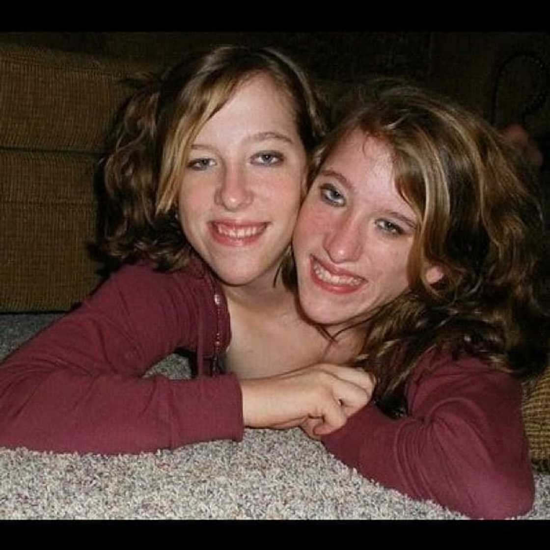 Abby and Brittany Hensel separated Abby and Brittany Hensel separated