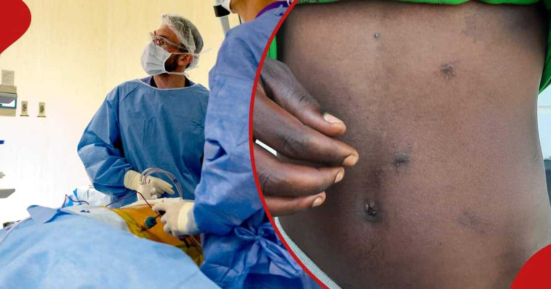 A kidney donor (right) shows the incision on his body. Doctors is an operating theatre (left) A kidney donor (right) shows the incision on his body. Doctors is an operating theatre (left)