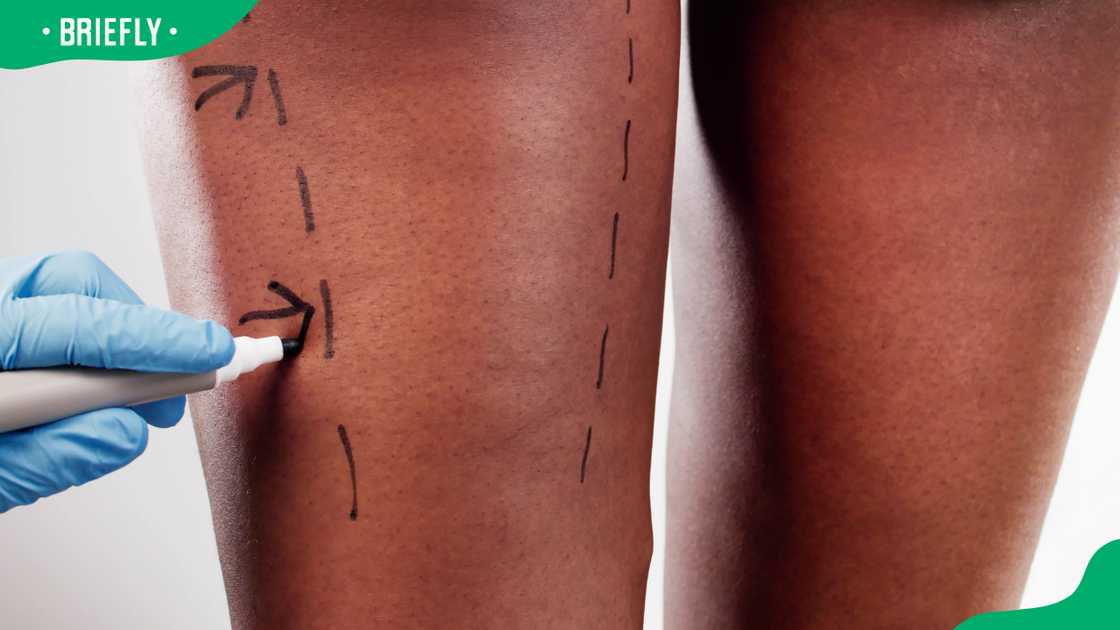 Types of liposuction procedures in South Africa