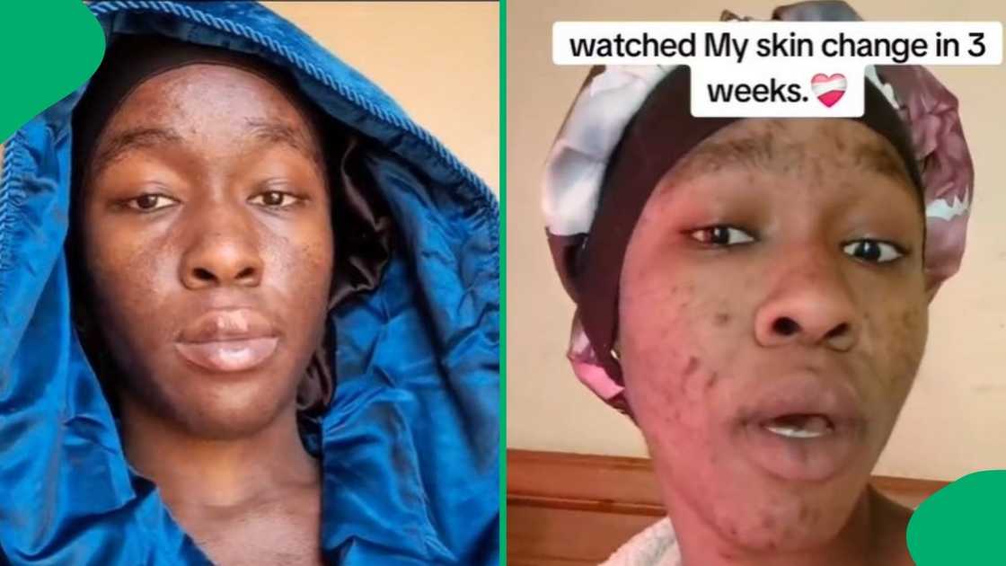 A woman showed how her skin transformed three weeks after using a prescribed medication. A woman showed how her skin transformed three weeks after using a prescribed medication.