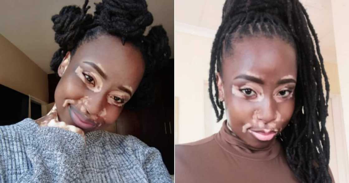 Model, Vitiligo, Stunning, Pics, Twitter reactions