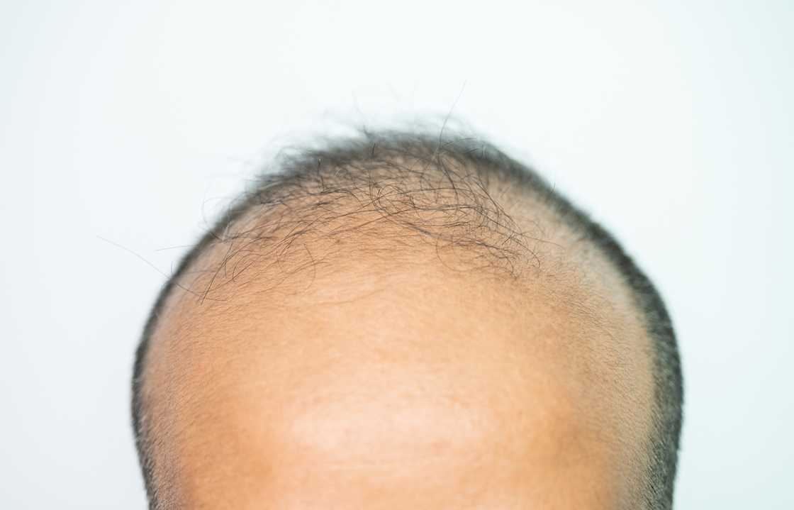 A bald man with a big forehead