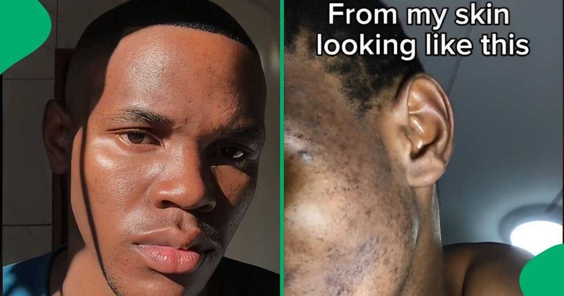 A man shared a video showing his 20-day hyperpigmentation improvement journey on TikTok