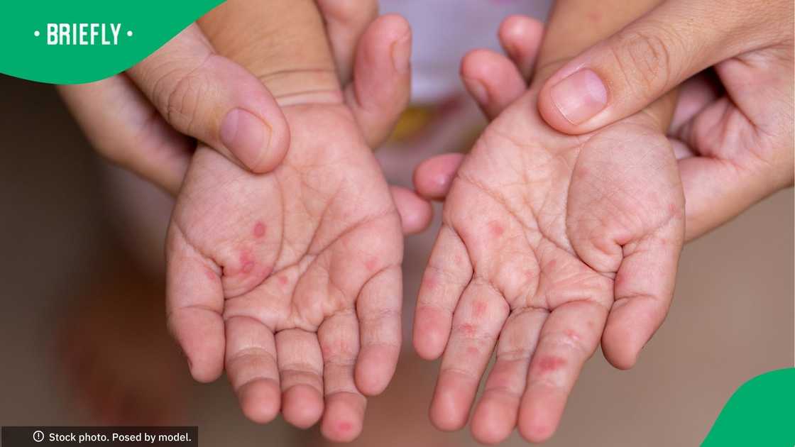 Hand Foot Mouth Disease Hand Foot Mouth Disease
