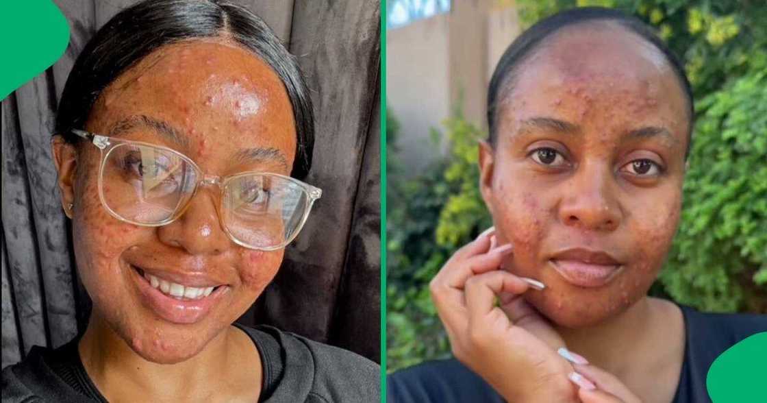 A South African woman showed off her major skin glow-up in a TikTok video. A South African woman showed off her major skin glow-up in a TikTok video.
