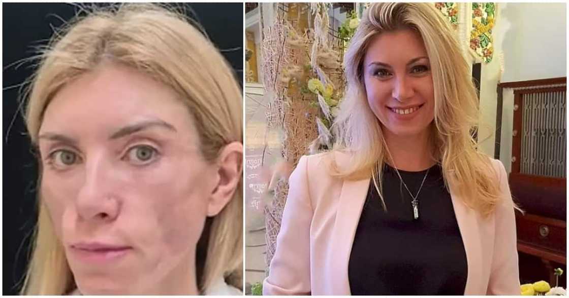 43-year-old beauty queen who cannot smile or close her eyes again after undergoing plastic surgery 43-year-old beauty queen who cannot smile or close her eyes again after undergoing plastic surgery