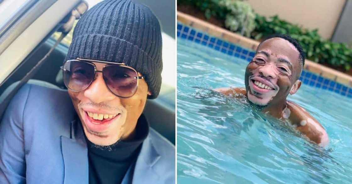 Skin conditions, Vitiligo, South Africa, Man, Flexes Rare Melanin Skin, Photo, Mzansi Skin conditions, Vitiligo, South Africa, Man, Flexes Rare Melanin Skin, Photo, Mzansi