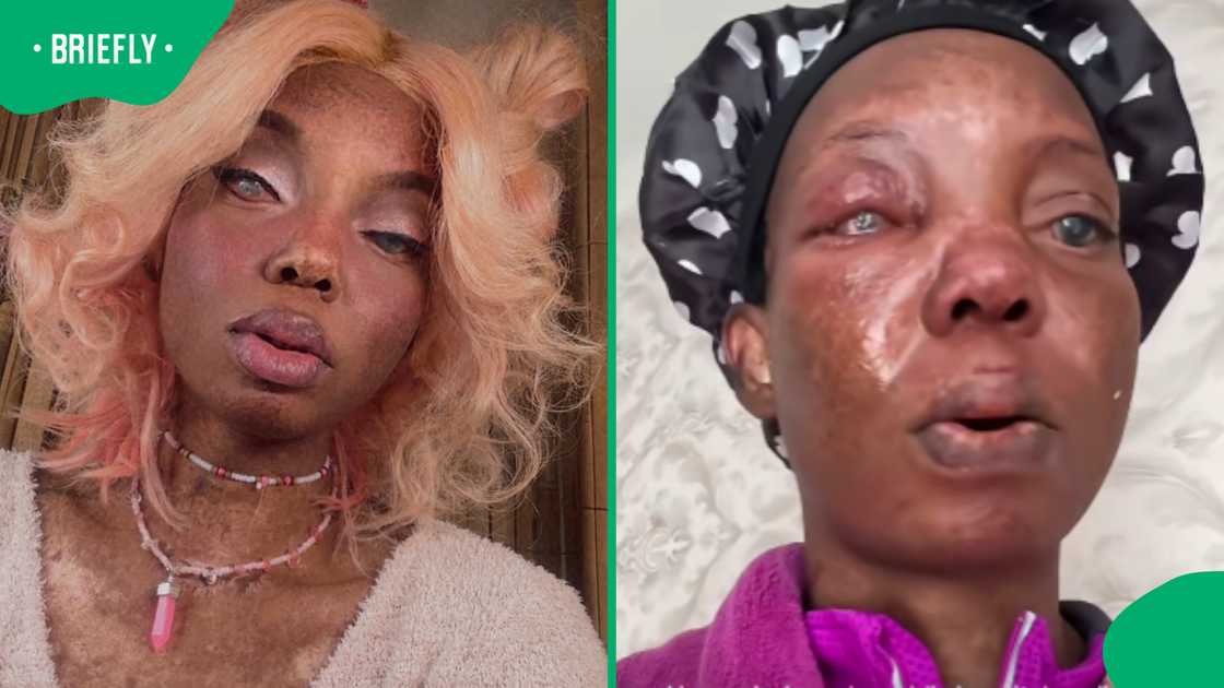 KZN woman seeks urgent medical help after fearing Stevens-Johnson syndrome reaction