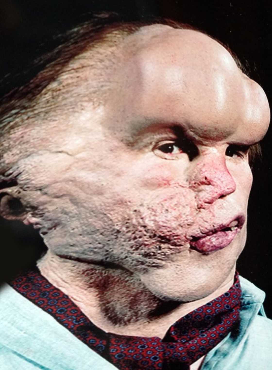 John Hurt as Joseph Merrick in the Elephant Man movie John Hurt as Joseph Merrick in the Elephant Man movie