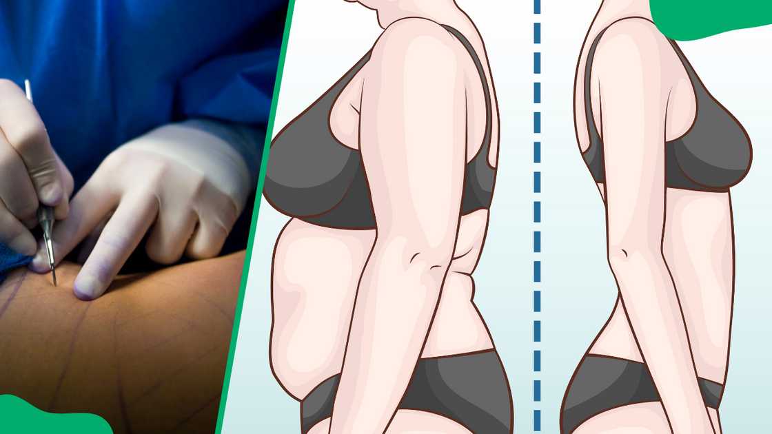 How much is liposuction in South Africa