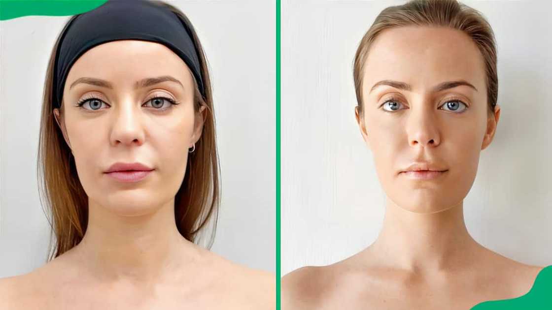 Trap Botox before and after.