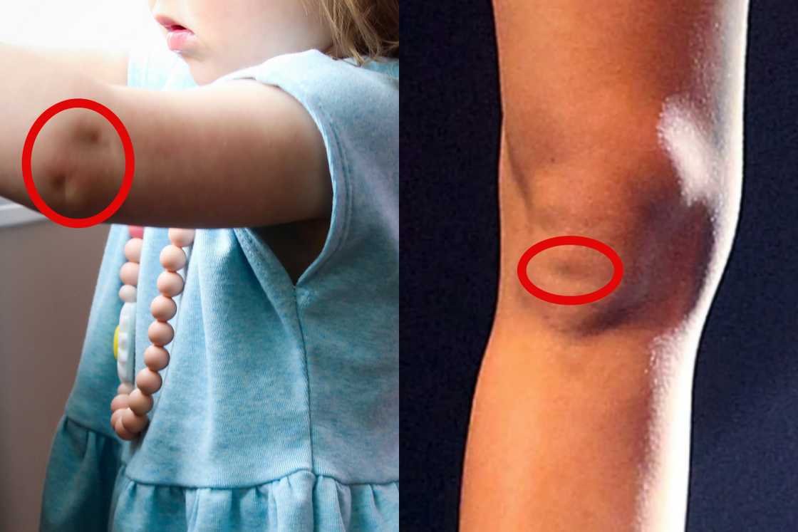 Elbow and knee dimples Elbow and knee dimples