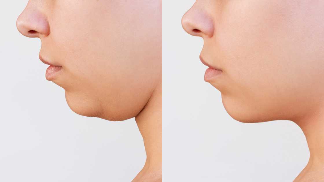 Double chin liposuction Double chin liposuction