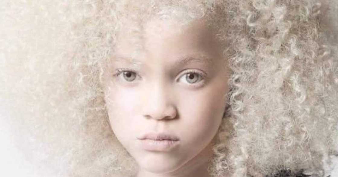Beautiful Girl, Albinism, Mzansi, Twitter reactions Beautiful Girl, Albinism, Mzansi, Twitter reactions