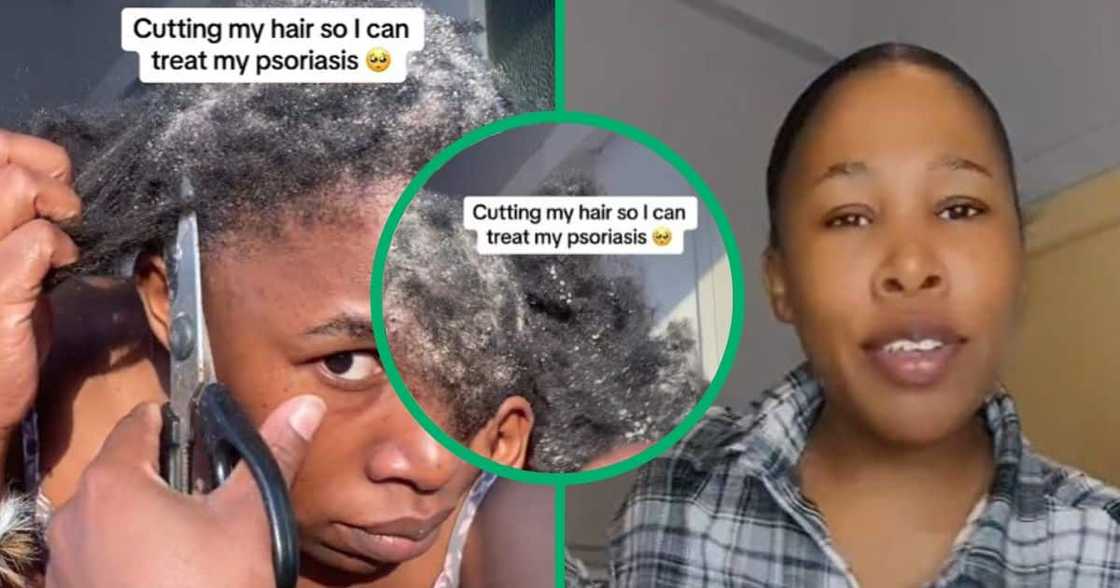 TikTok video of psoriasis sufferer cutting hair TikTok video of psoriasis sufferer cutting hair
