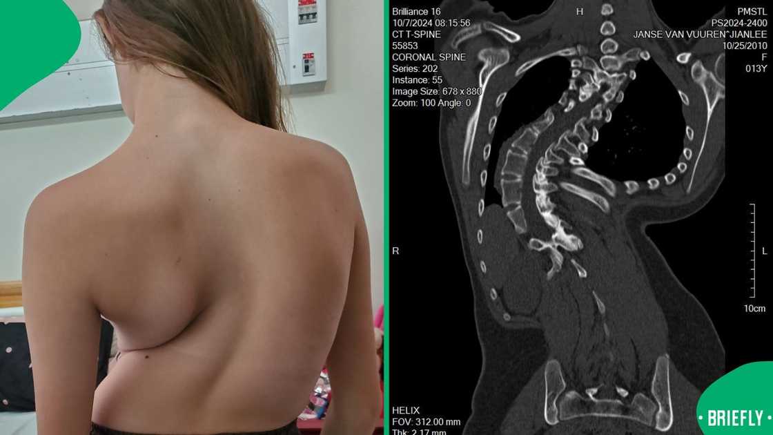 A girl with scoliosis. A girl with scoliosis.