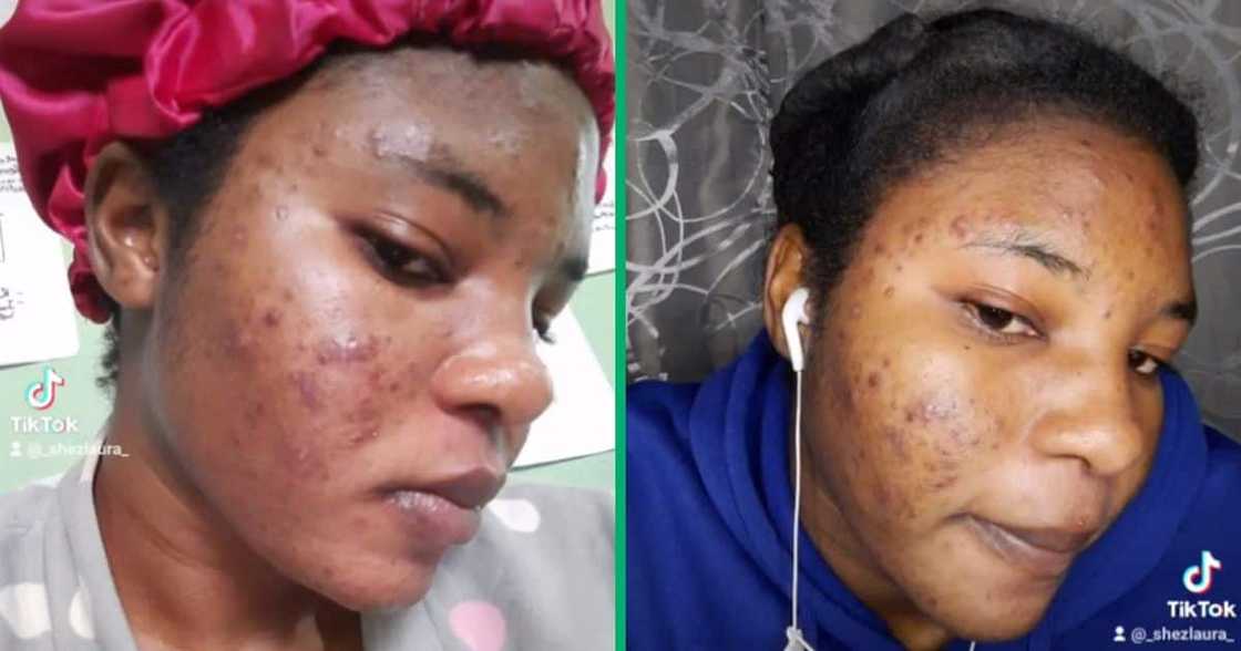 Woman with acne Woman with acne