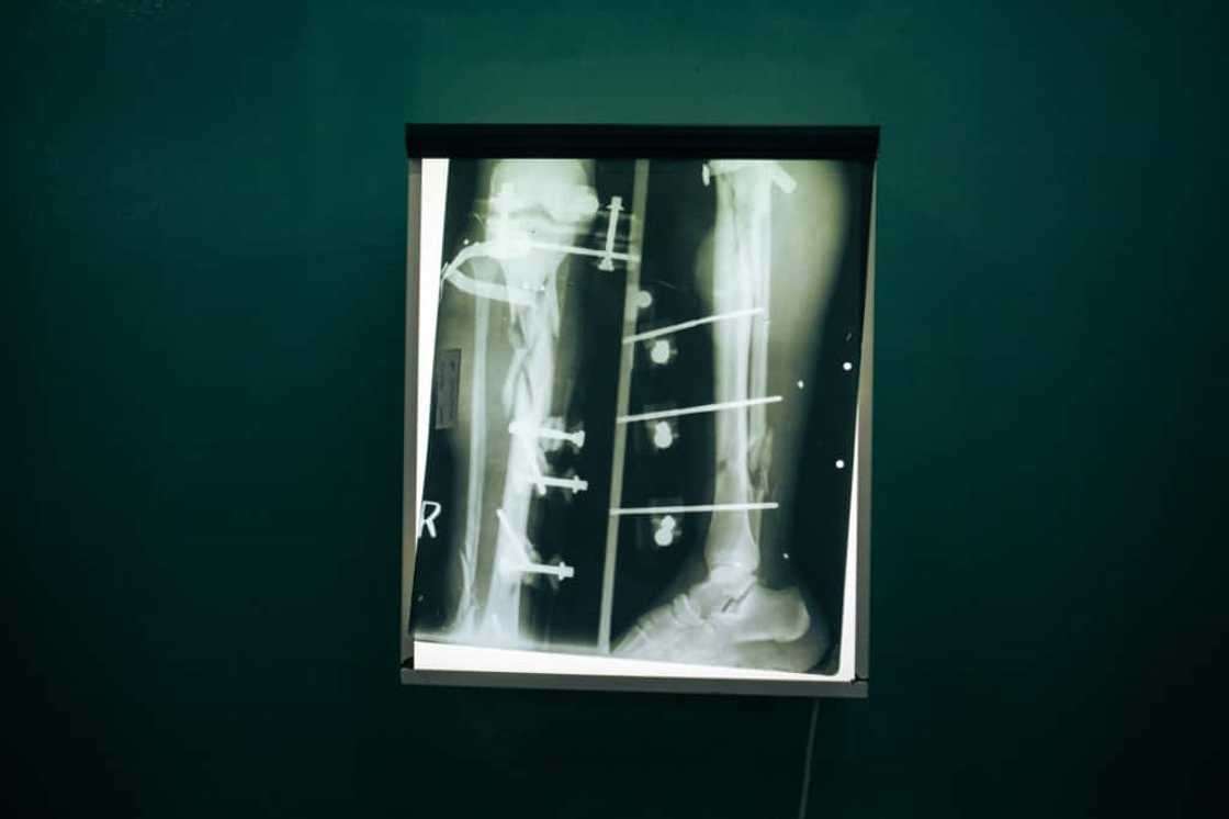 An X-ray of a wounded Congolese soldier's leg An X-ray of a wounded Congolese soldier's leg