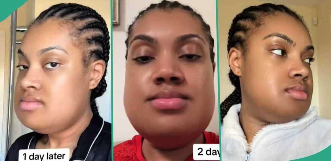 Lady shares recovery from her underbite jaw surgery. Lady shares recovery from her underbite jaw surgery.