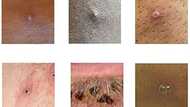 Monkeypox vaccine maker Bavarian Nordic ready to meet demand