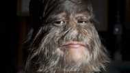 Supatra Sasuphan: Meet the world's hairiest girl
