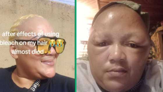 Mzansi woman shows disturbing hair bleaching aftermath on TikTok, says she almost died