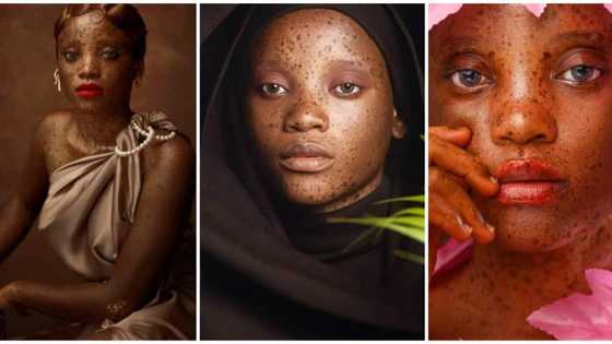 Pretty lady with a rare skin condition opens up in new video