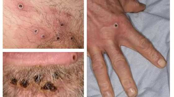 WHO emergency committee meets on monkeypox