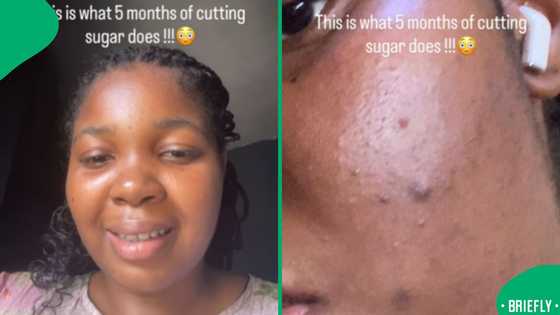 Woman reveals stunning skin transformation after cutting sugar for 5 months