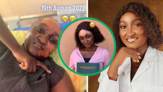 Woman's face scarred in a final year project still graduates as a pharmacist despite challenges