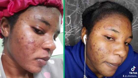 Blocked for breakouts?: Woman shares glow-up after battling with acne in viral TikTok video
